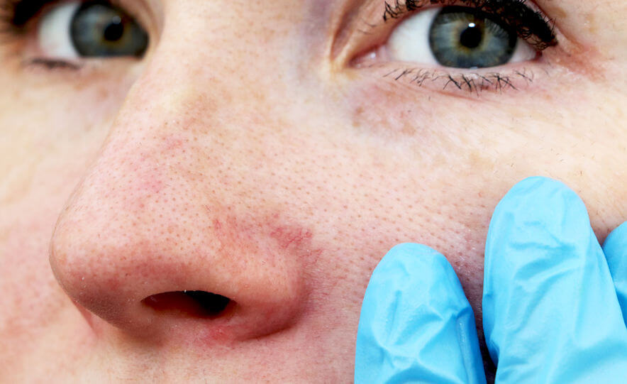 Kuperóza môže byť príčina, prečo sa na tele či tvári objavia červné fľaky